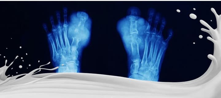 WORLD DAIRY NEWS Milk and other dairy products may benefit people with gout