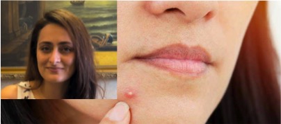 Avoid dairy and high glycemic index food if you have acne - Dairy News 7X7